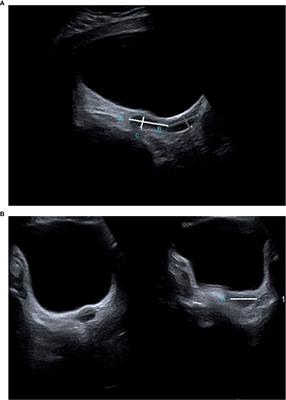 Uterine Development During Induced Puberty in Girls with Turner Syndrome